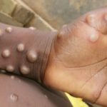 Un enfant atteint de la variole du Singe (Image d'illustration)