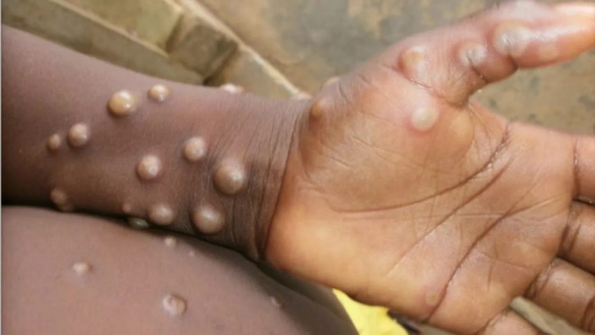 Un enfant atteint de la variole du Singe (Image d'illustration)